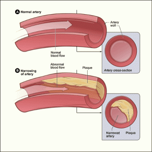 atherosclerosis NIH